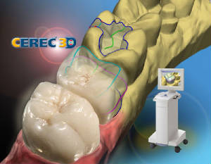 Crowns in one day with our Cerec system